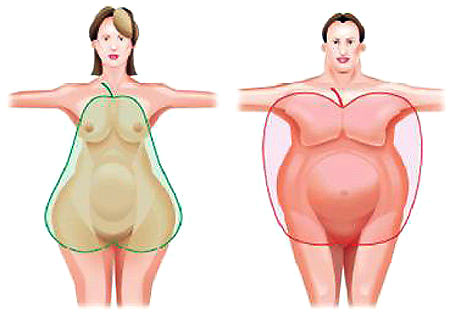 женский и мужской тип ожирения