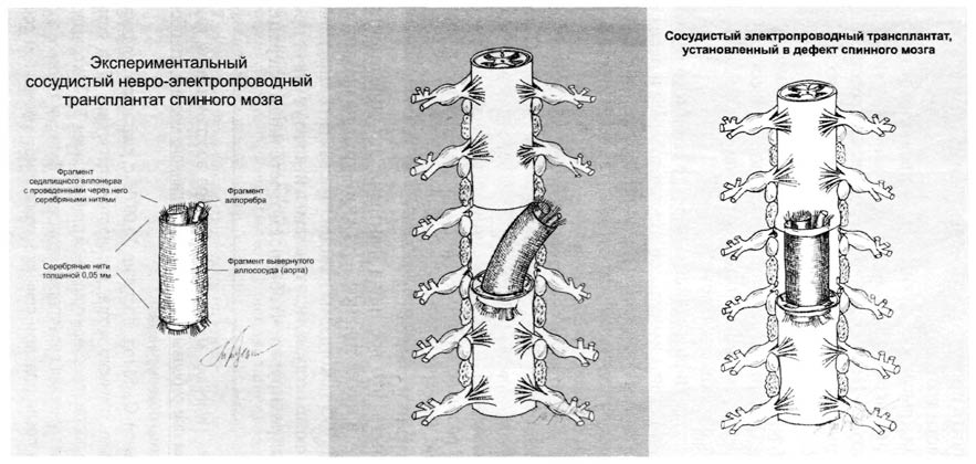Схема имплантации сосудисто-неврального трансплантата в дефект спинного мозга