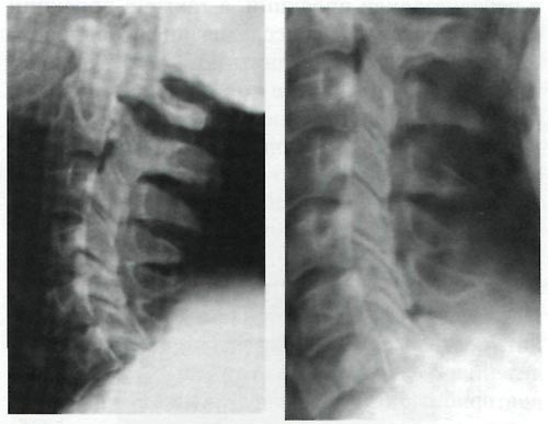 Рентгенограмма шейного отдела позвоночника