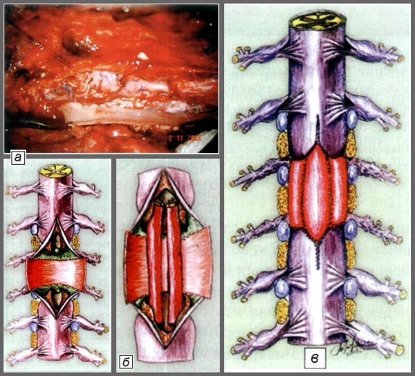 Пластика дефекта спинного мозга двумя сосудисто-невральными трансплантатами