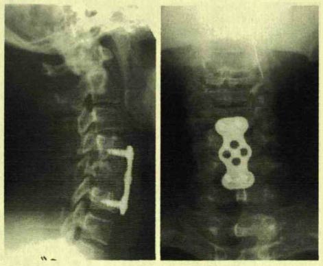 рентгенограммы больного С