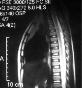МР-томография позвоночника