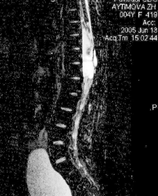МРТ больной А., 5 лет. Обширная посттравматическая ликворная киста в области травмы спинного мозга