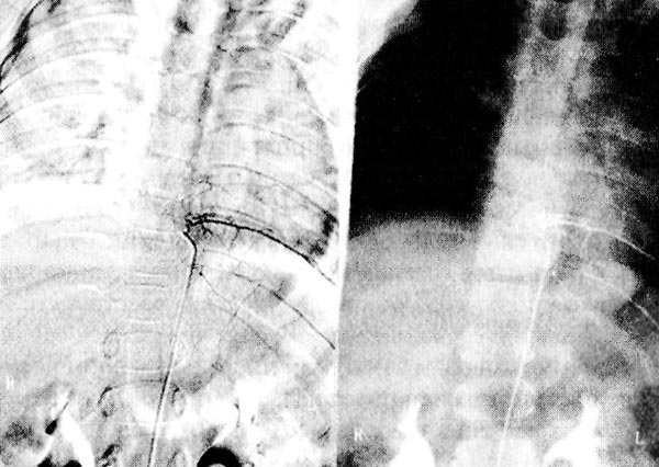 Ангиограмма больной А., 5 лет. Окклюзия нисходящего отдела передней спинальной артерии