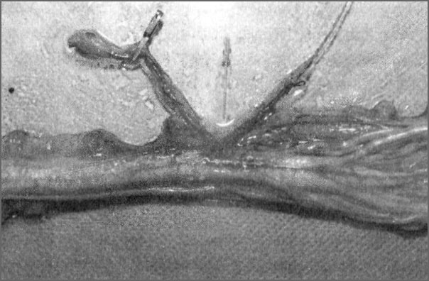 Микрососудистый анастомоз «бок в бок» вены с артерией Адамкевича