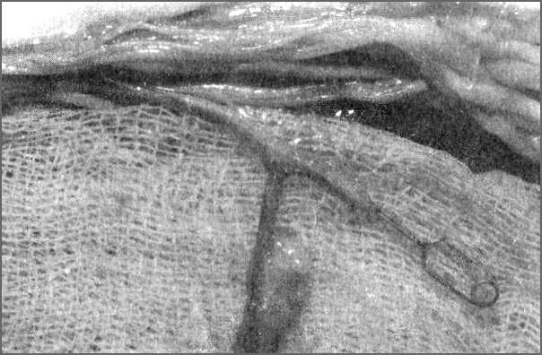 Микрососудистый анастомоз вены «конец в бок» с артерией Адамкевича