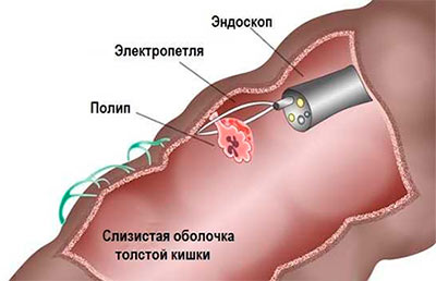 эндоскопическая полипэктомия