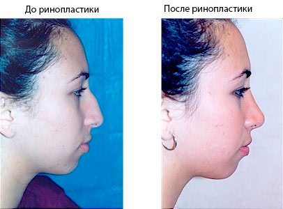 женщина до и после ринопластики