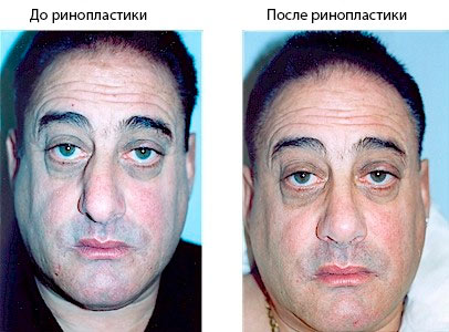 мужчина до и после ринопластики