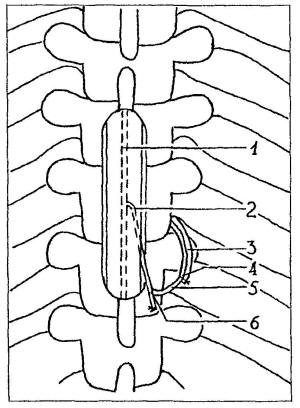 Схема операции наложения микрососудистого анастомоза между артерией Адамкевича и межреберной артерией
