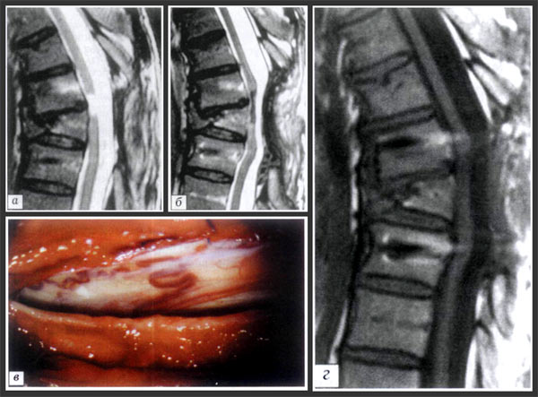 травматическая болезнь спинного мозга, последствия перелома Т7-го позвонка