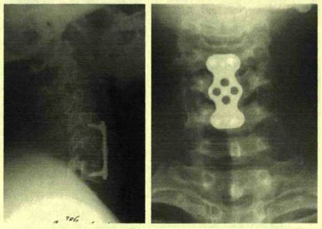 послеоперационные рентгенограммы