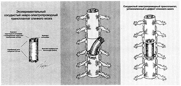 Схемы имплантации сосудисто-невро-электропроводного трансплантата в дефект спинного мозга