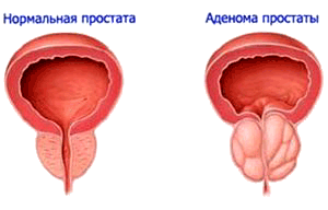 простата, аденома простаты