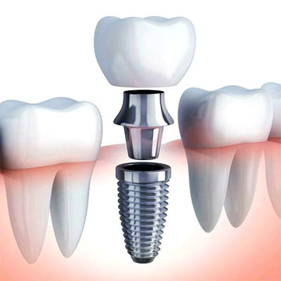 Операция имплантации зубов
