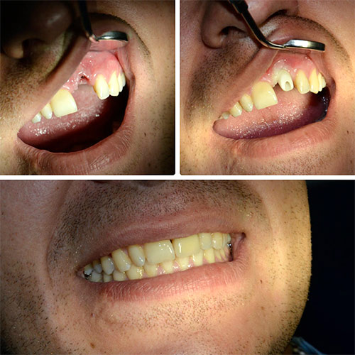 виды имплантов зубов